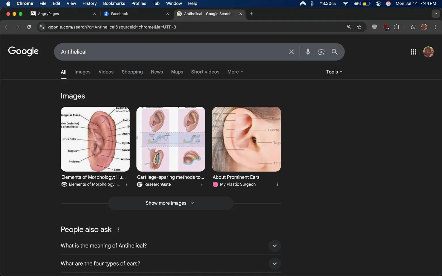 The image displays a Google search results page for the term "Antihelical." The background is dark, typical of a night mode interface. At the top, the search bar shows the term "Antihelical" with a small icon indicating the search source. Below the search bar, there are several images related to ear anatomy. 

1. The first image is a detailed anatomical diagram of an ear, labeling parts such as the "superior crus of antihelix," "tragus," and "incisura."
2. The second image features illustrations demonstrating cartilage-sparing methods, likely in the context of ear surgery.
3. The third image shows a close-up of an ear with labeled parts, including "fossa" and "concha."

Under the images, there are questions like "What is the meaning of Antihelical?" and "What are the four types of ears?" The overall tone is educational, focusing on anatomical and surgical aspects of ear structure. No identifiable individuals or sensitive content are present.