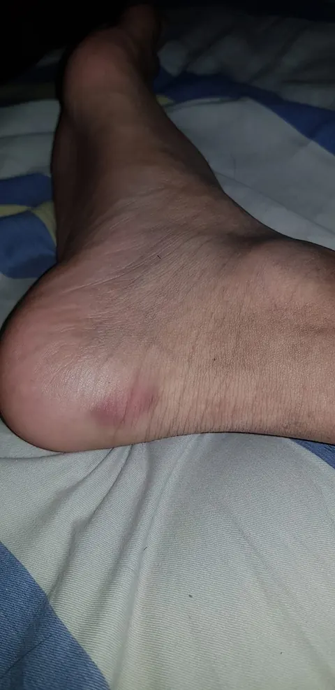 A Possible Tick Bite Turns Into a Case Against Generic Drugs and Lost Time